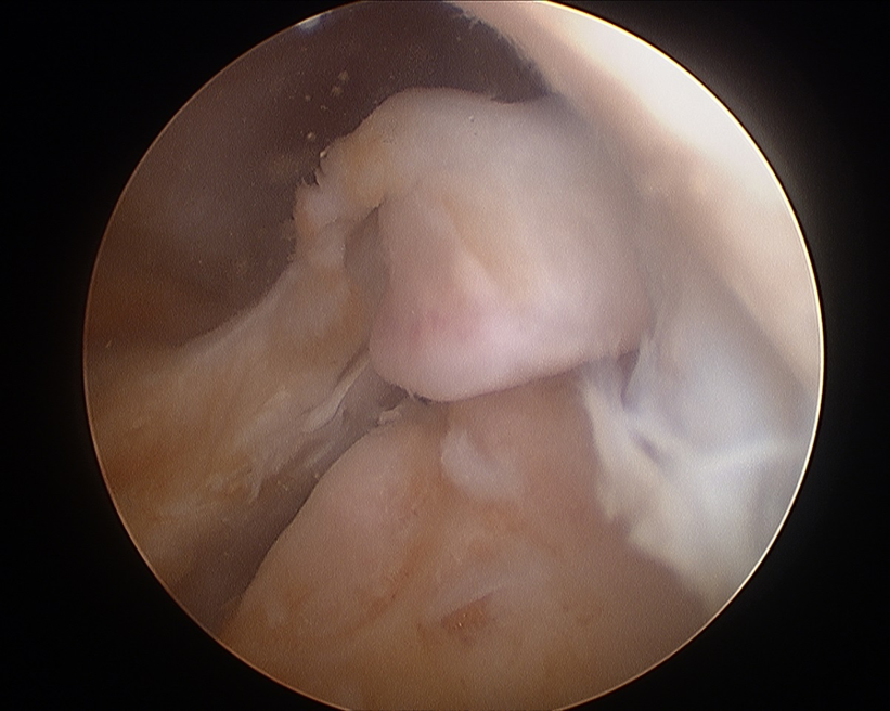 Meniscal Root Tear